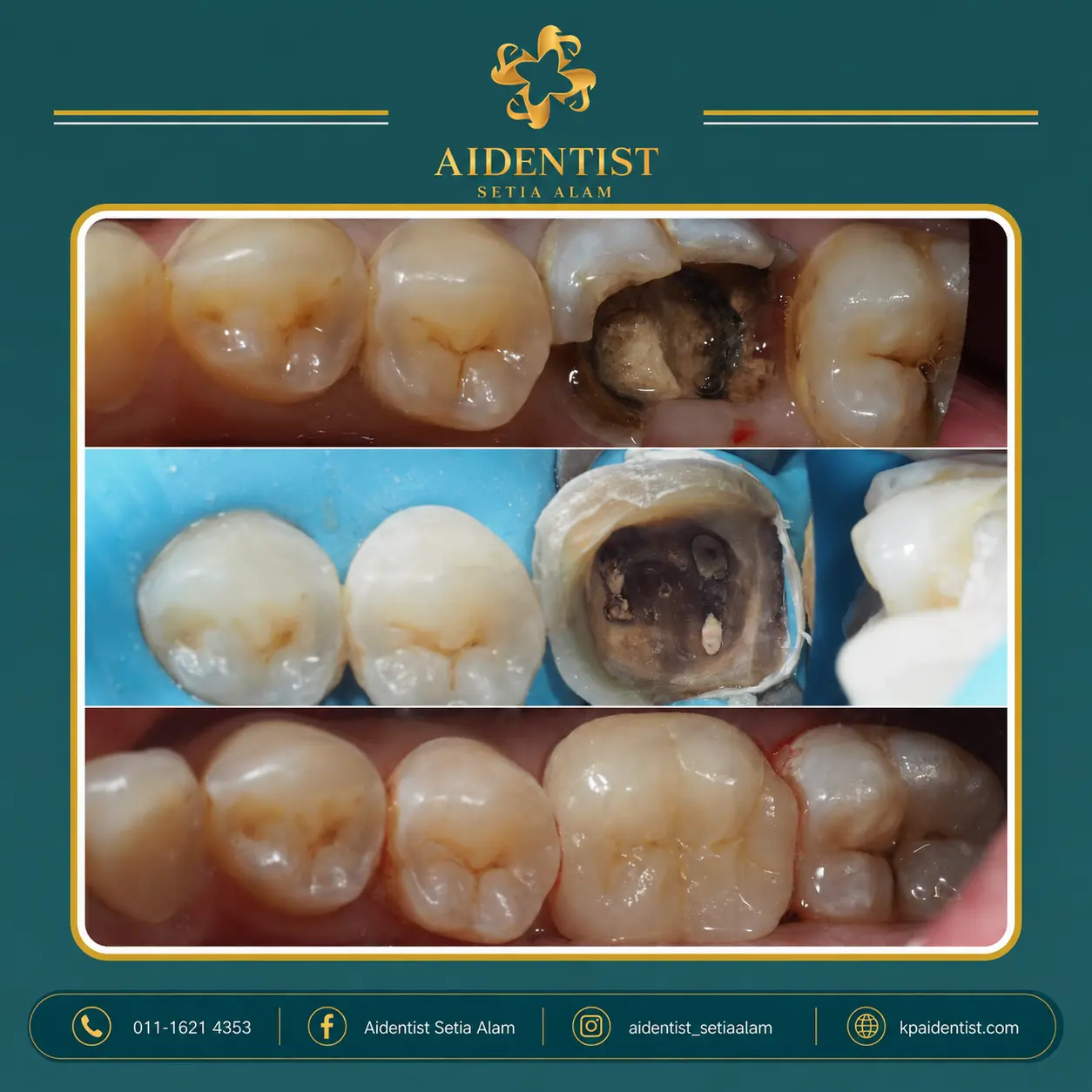 Aidentist dental work case 5