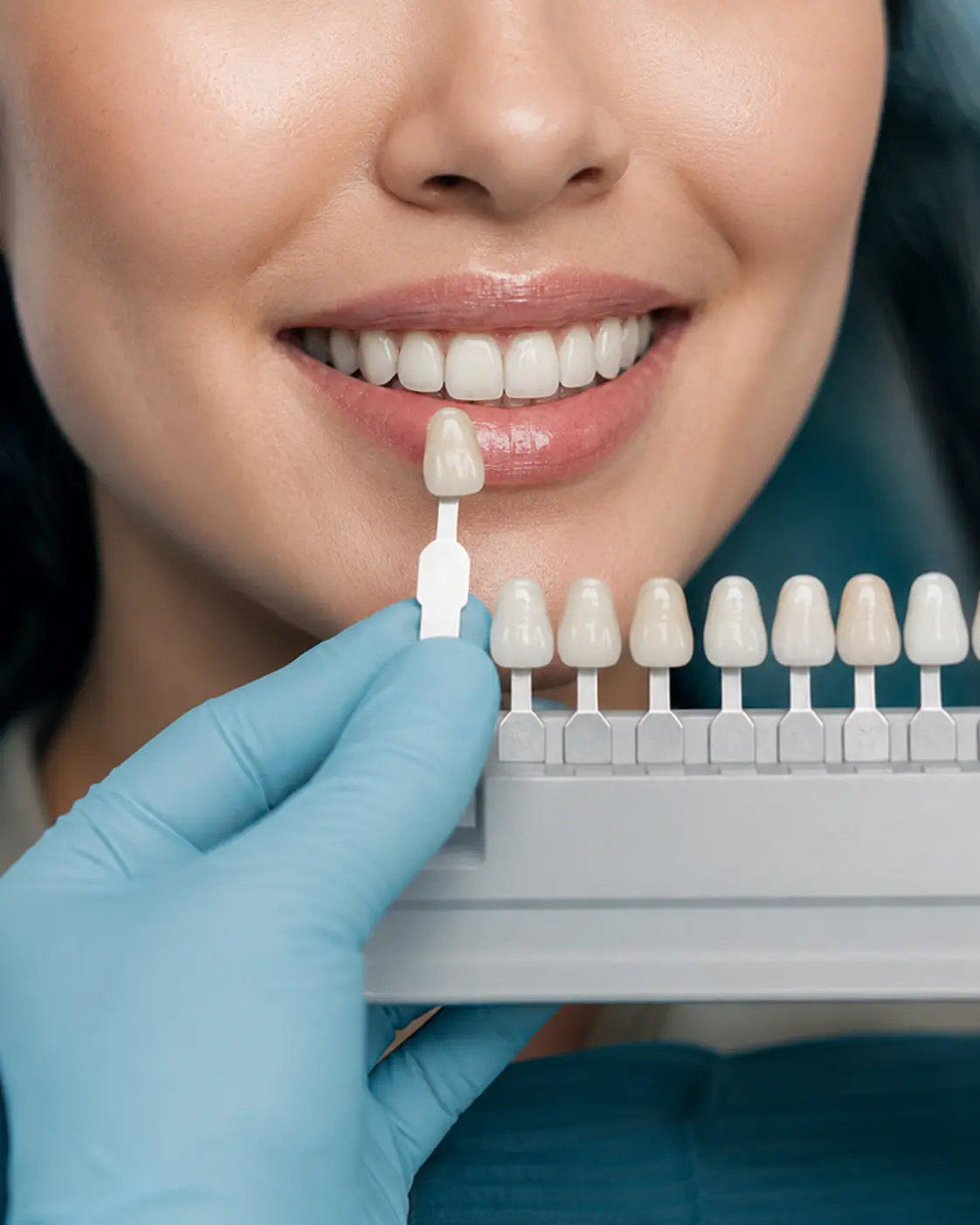 Veneers